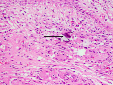 Histopathology from the edge of sinus showing a granulomatous tissue reaction with epithelioid cells, Langhans giant cells and calcium deposits (arrow) in the dermis (H&E, ×400)