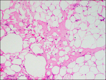 Histopathology from the buttock plaque showing lobular panniculitis with hyaline necrosis, and macrocyst and microcyst formation (H&E, ×400)