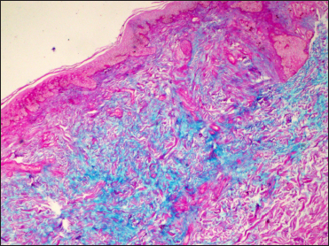 Prominent dermal mucin deposition (Alcian blue, ×100)