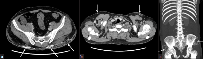 CECT of chest, abdomen and pelvis showing multiple areas of soft tissue calcification (arrows) over (a) upper anterior chest, (b) lower back and (c) around bilateral hip joints