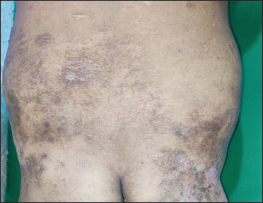 Resolution of the dyspigmented plaques over lower back and right buttock. Guttate hypopigmented papules over the lower back have completely resolved