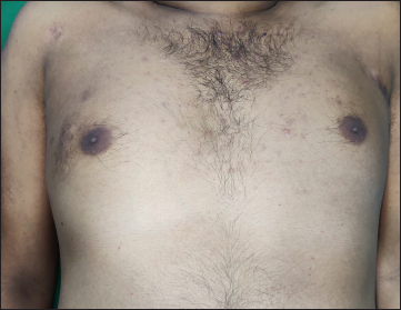 Residual post-inflammatory hyperpigmentation after healing of dyspigmented plaque on right chest.