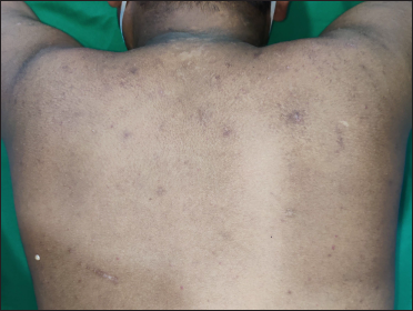 Upper back shows complete healing of guttate hypopigmented papules and plaques