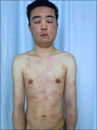 Swelling of both eyelids and face. Oedematous dark erythema, papules, hyperpigmentation and crust were noted on the limbs and trunk