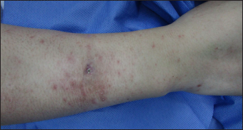 Oedematous dark erythema, papules, hyperpigmentation and crust were noted on the right forearm