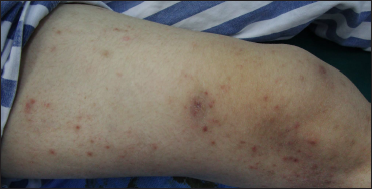 Oedematous dark erythema, papules and crust were noted on the right thigh