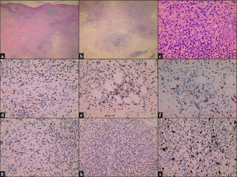 (a) Large number of inflammatory cells were observed in the whole dermis (H&E,×40), (b) A large number of inflammatory cells were observed in the subcutaneous adipose layer (H&E,×40), (c) Some of the infiltrates were prominently composed of medium-sized atypical lymphocytes that had clear cytoplasm with irregularly shaped nuclei (H&E,×200), (d) CD2 positive (×200), (e) CD3 positive (×200), (f) CD5 positive (×200), (g) CD7 positive (×200), (h) EBER-positive (×200), (i) The Ki-67 proliferative index was approximately 20% (×200).