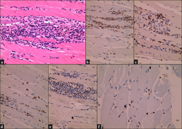 (a) A large number of medium-sized atypical lymphocytes with irregularly shaped infiltrated muscle fibre (H&E,×400), (b) CD3 positive (×400), (c) CD5 positive (×400), (d) CD8 positive (×400), (e) EBER-positive (×400), (f) The Ki-67 proliferative index was approximately 20% (×400).