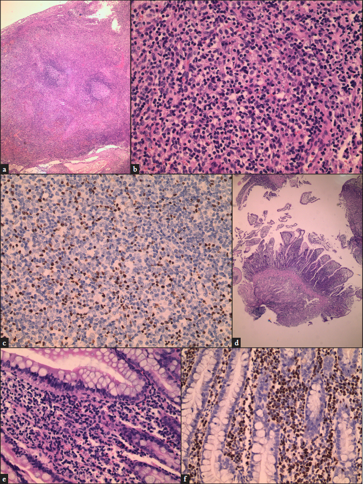 (a) A large number of lymphocytes infiltrated the paracortical area of lymph node (H&E,×40), (b) A large number of medium-sized atypical lymphocytes with irregularly shaped infiltrated the paracortical area of lymph node (H&E,×100), (c) EBER-positive (×200), (d) A large number of lymphocytes infiltrated the ileum (H&E,×40), (e) A large number of medium-sized atypical lymphocytes with irregularly shaped infiltrated the ileum (H&E,×400), (f) EBER-positive (×200).