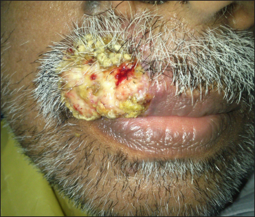 Solitary verrucous plaque over the right lateral aspect of the upper lip extending into the mucosa