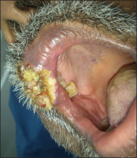 Solitary verrucous plaque over the right lateral aspect of the upper lip extending into the mucosa