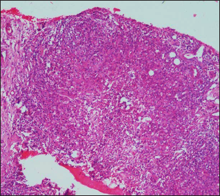 Epitheloid cell granulomas with Langhans type giant cells admixed with inflammatory infiltrate in the dermis (Haematoxylin-eosin ×100)