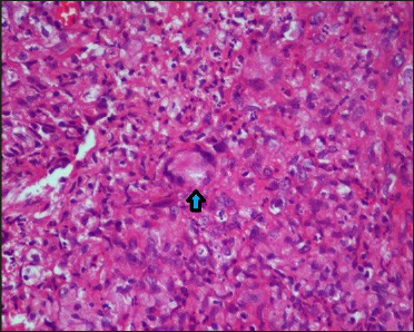 Epitheloid cell granulomas with Langhans type giant cells (blue arrow) (Haematoxylin-eosin ×400)