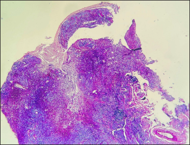 Epitheloid cell granulomas admixed with inflammatory infiltrate in the dermis (Periodic acid-Schiff stain ×40)