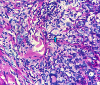 Fungal elements as budding yeasts within the Langhans giant cells (blue arrow) in the granuloma (Periodic acid-Schiff stain ×400)