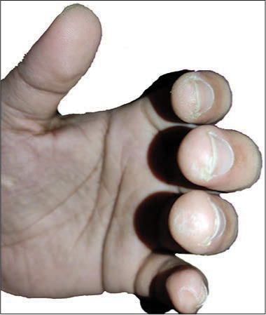 Guitarist’s fingers: These present as calluses at the sides and tips of the fingers