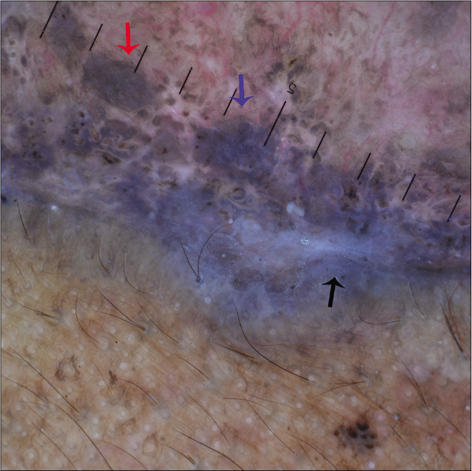 Dermoscopic examination under nonpolarized contact dermoscopy (HEINE DELTA20® Dermatoscope, ×10) showing large brown-gray (red arrow), blue-gray (blue arrow) ovoid nests and blue-white veil (black arrow)