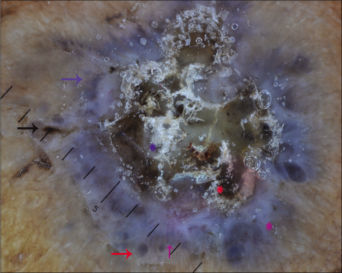 Dermoscopic examination under nonpolarized contact dermoscopy (HEINE DELTA20® Dermatoscope, ×10) showing blue-gray aggregate (blue arrow), gray-brown ovoid nests (red arrow), blue-white veil (purple Asterix), brown blotch (red Asterix), keratotic scales (blue Asterix) and hairpin vessels (purple arrow)