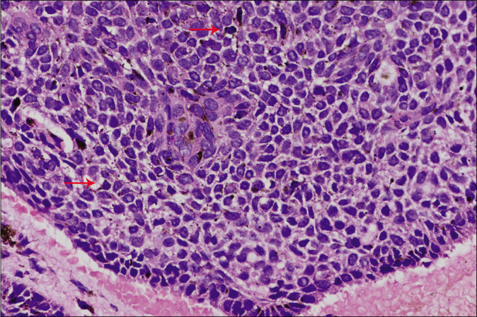 Basaloid lobule showing colonization by dendritic melanocytes (arrows, H and E, ×400)