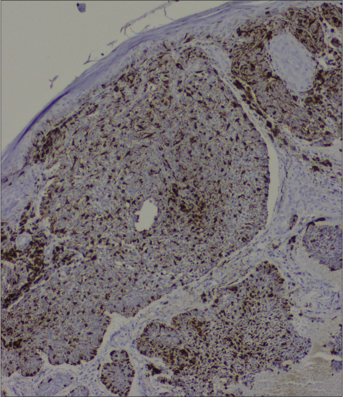 Melan-A demonstrating melanocyte colonization inside basaloid lobules (immunohistochemistry, ×100)