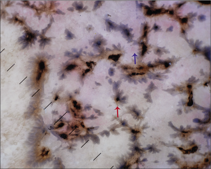 Dermoscopic examination under nonpolarized contact dermoscopy (HEINE DELTA20® Dermatoscope, ×10) showing short fine telangiectasia (blue arrow) and spoke wheel pattern (red arrow)