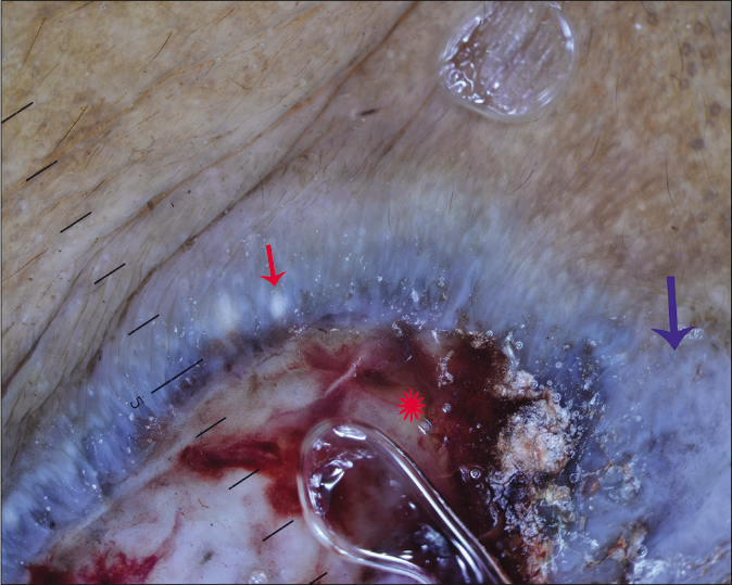 Dermoscopic examination under nonpolarized contact dermoscopy (HEINE DELTA20® Dermatoscope, ×10) of a nodular basal cell carcinoma dominated by a blue-white veil (arrow), ulceration (Asterix) and milia-like cyst (red arrow)