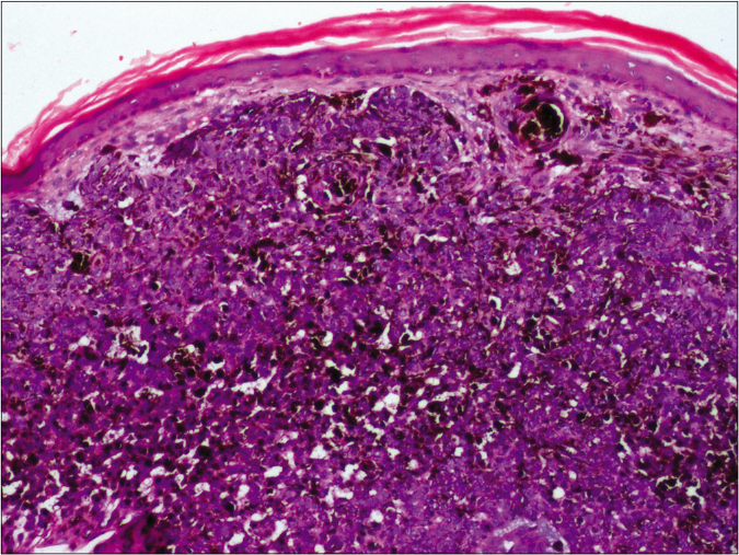 Densely pigmented basaloid cells with overlying compact orthokeratosis corresponding to the blue-white veil (H and E, ×100)