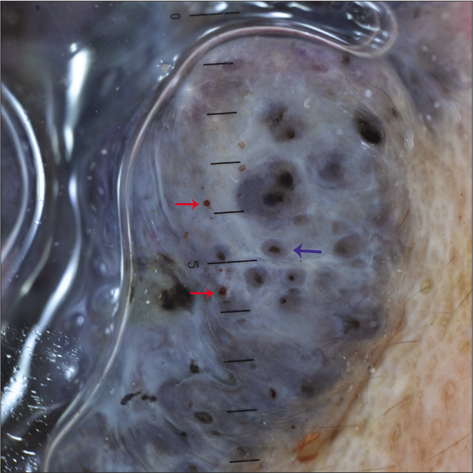 Dermoscopic examination under nonpolarized contact dermoscopy (HEINE DELTA20® Dermatoscope, ×10) showing concentric structure (blue arrow) and red globules (red arrows)