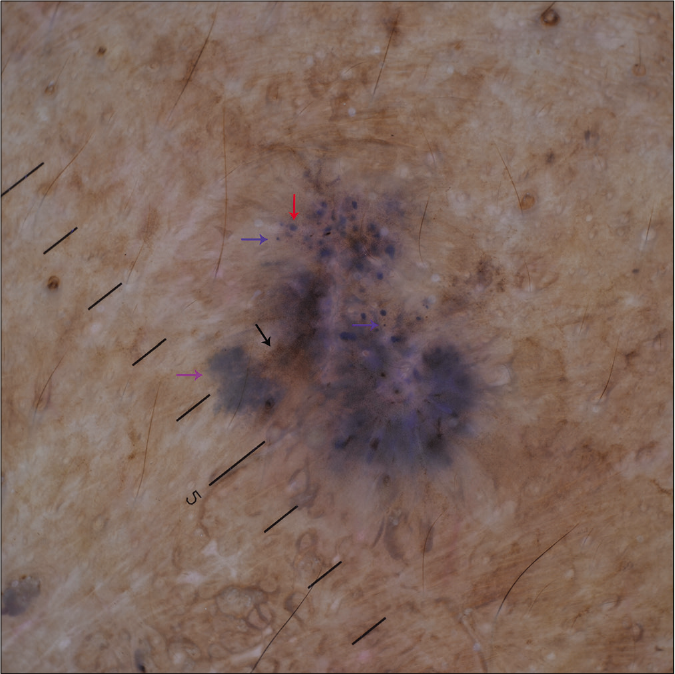 Dermoscopic examination under nonpolarized contact dermoscopy (HEINE DELTA20® Dermatoscope, ×10) showing in-focus dots (blue arrows), blue-gray globules (red arrow), maple leaf-like area (purple arrow) and fine brown peppering (black arrow)