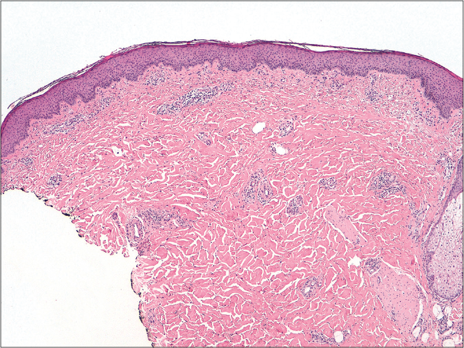 Mild perivascular inflammatory infiltrate, without significant epidermal alterations, collagen degeneration or palisade granulomas that could suggest necrobiosis lipoidica (hematoxylin-eosin, ×40 )