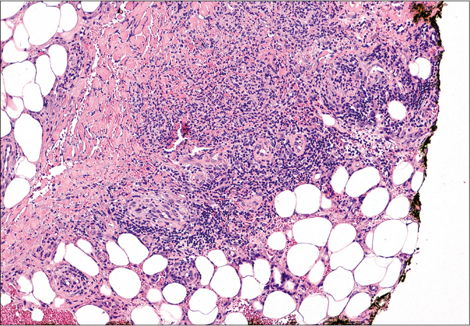 Lymphohistiocytic inflammatory infiltrate in the subcutaneous tissue, affecting mainly the septa with fibrous thickening and granuloma formation. There was no vasculitis (hematoxylin-eosin, ×100)