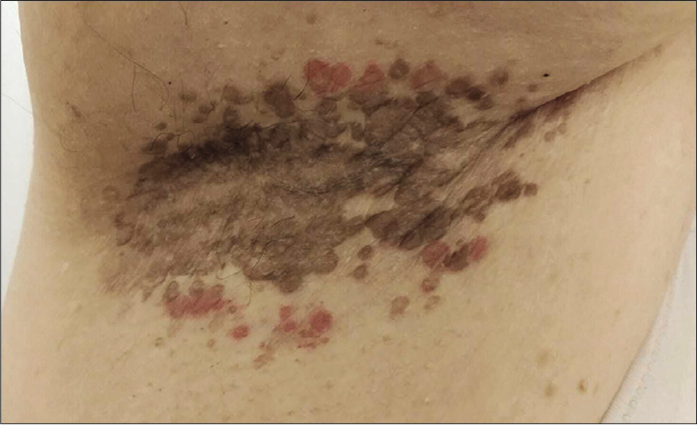 Right axilla with brown and red hyperkeratotic papules and plaques plaque