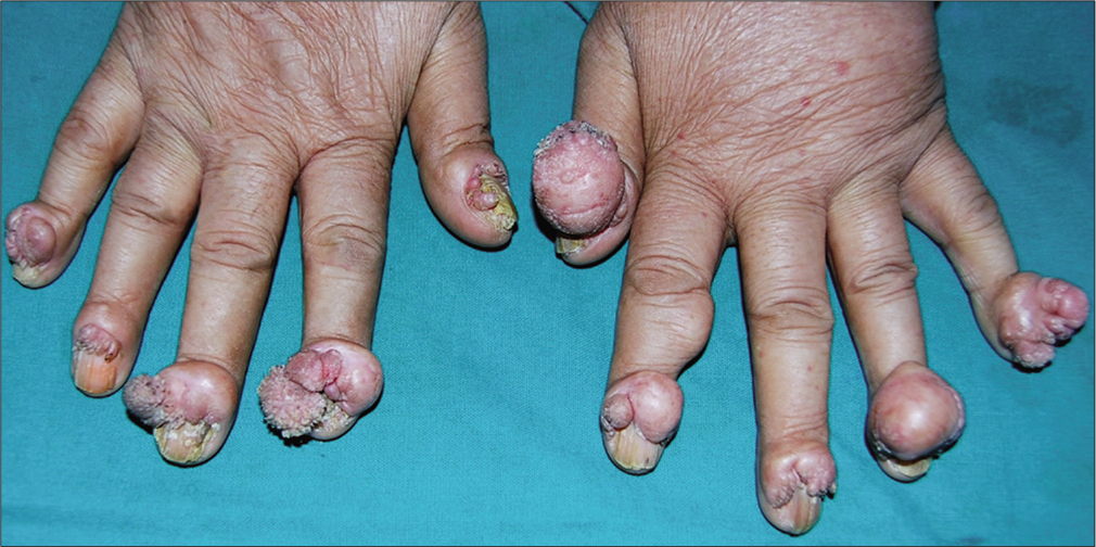 Lobulated tumors and nodules, some of them smooth surfaced and some showing filiform projections involving the proximal and lateral nail folds of all fingers