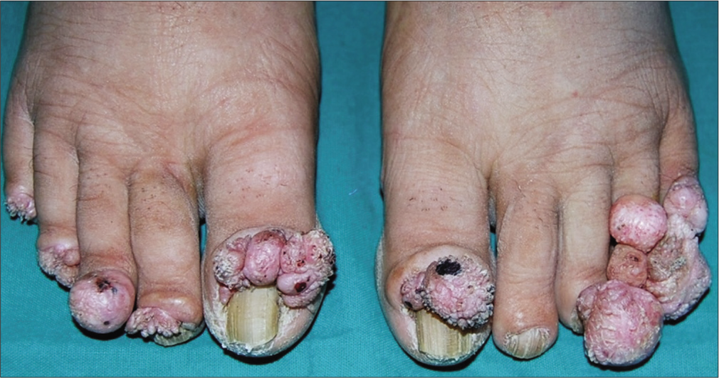 Lobulated tumors and nodules showing minute filiform projections involving proximal and lateral nail folds of all toes, except second left toe
