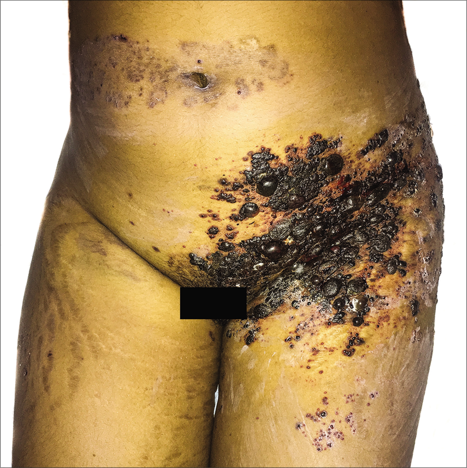 Multiple hemorrhagic bullae and vesicles over the left abdomen and pelvic region