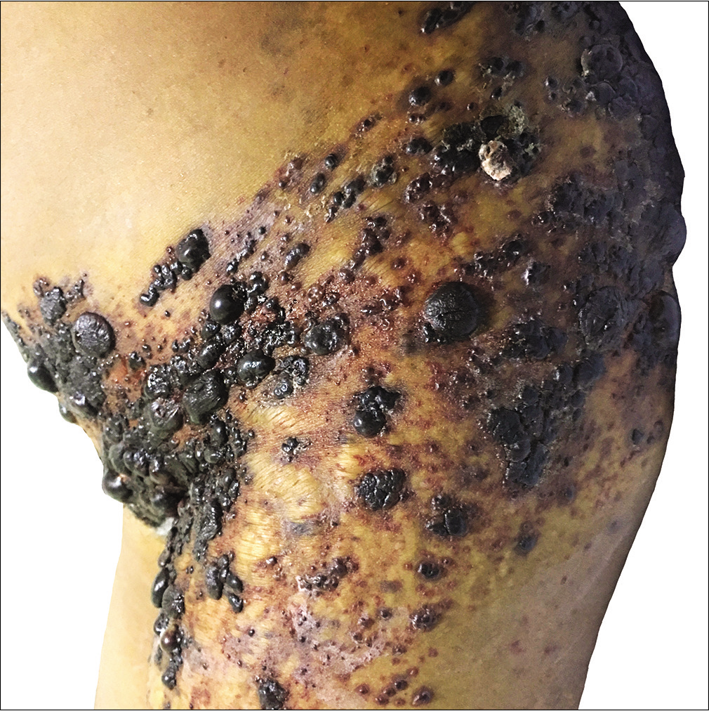 Numerous grouped hemorrhagic vesicles and bullae noted over the left hip and upper thigh