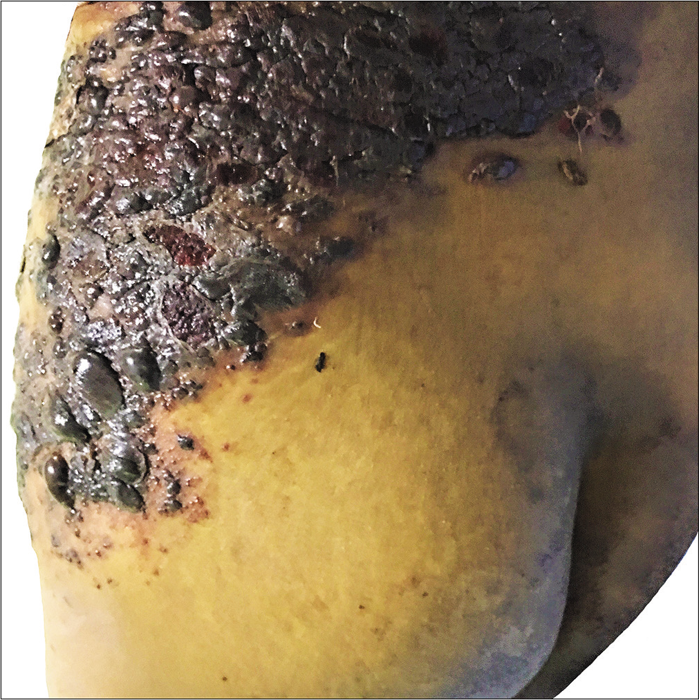 Lesions extending posteriorly to left lower back and gluteal region