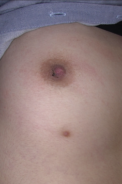 Slightly brownish hyperkeratosis is seen on the right inferolateral part of the nipple. Brownish plaque localised on the milk line on the underside of the right breast