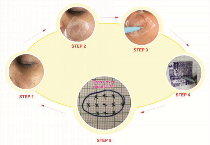 Illustrates the process involved in point counting serial image index. Step 1- identifying an index/reference image-includes melasma lesion along with adjoining normal skin for comparison. Step 2- Transparent polythene sheet is superimposed over a melasma lesion. Step 3- The margins of the lesion is traced. Step 4- Transparent sheet is superimposed over a carbon paper and traced on a graph paper. Step 5- The cross-over points are counted within the traced boundary. The number of cross over points represents the melasma area. In this case there are 11 cross - over points