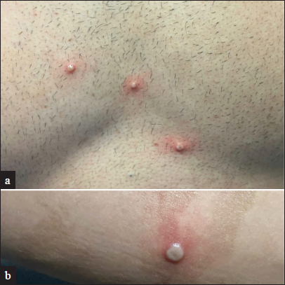 Cutaneous examination in a 30-year-old HIV-positive individual with undetectable viral load. Discrete vesiculo-pustules with an umbilicated centre and a prominent erythematous rim are seen on the chest (a) and right forearm (b). Polymerase chain reaction (PCR) testing from a lesional swab detected non-variola orthopox virus DNA