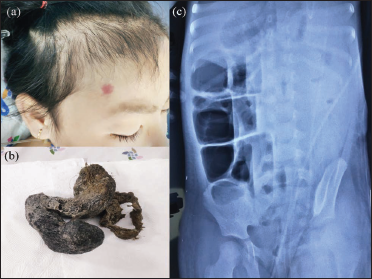 (a) Patchy hair loss on the scalp. (b) The hairy mass was removed. (c) Distended loops of bowel with the absence of colonic gas on the abdominal plain film