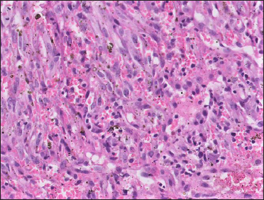 Fascicles of relatively monomorphic spindled cells, with slit-like vascular channels containing erythrocytes (H & E, ×40)