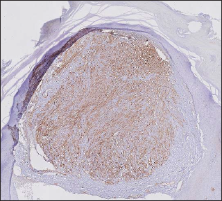 Immunohistochemistry for CD34 (× 10) showing diffuse nuclear positivity