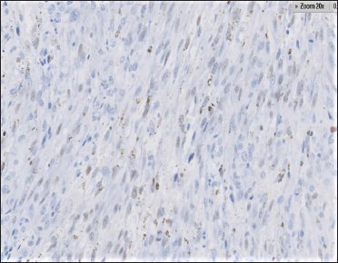 Immunohistochemistry for human herpes virus-8: Nuclei of tumour cells showing immunoreactivity ( × 40)