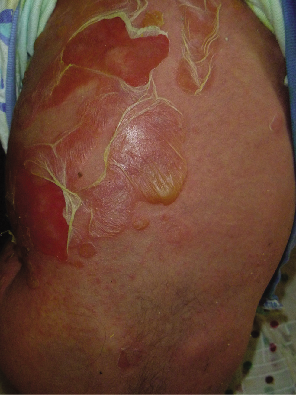 Erythroderma secondary to toxic shock syndrome.