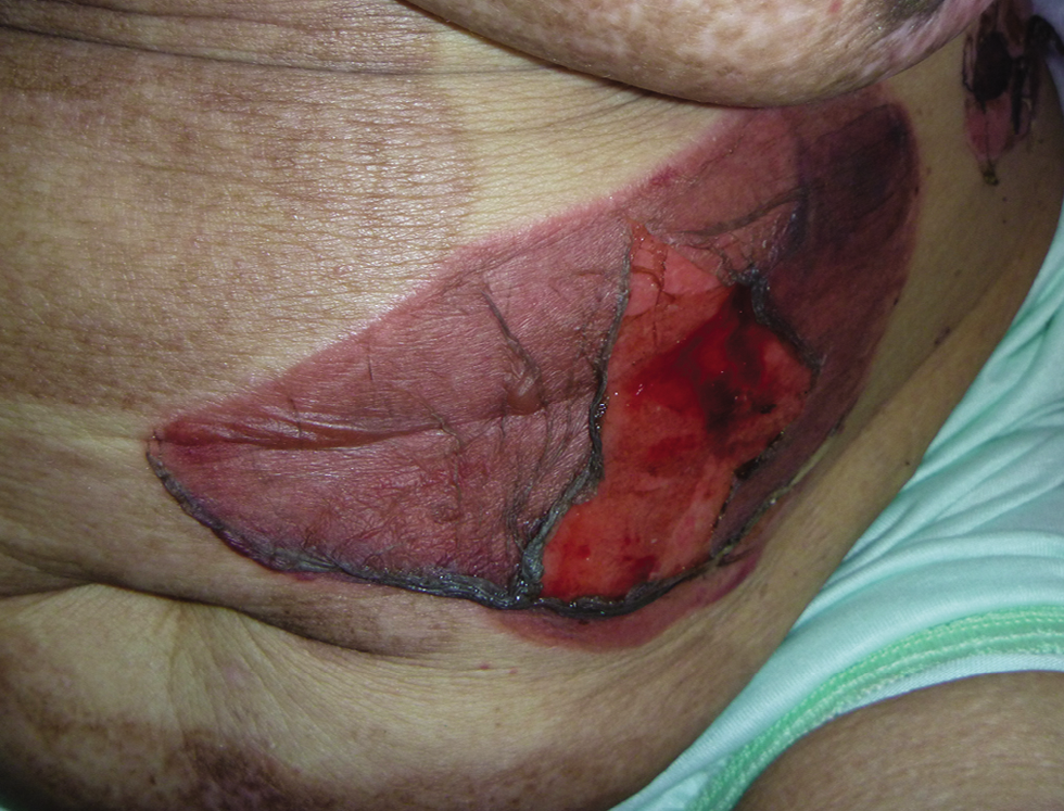 Bullous fixed drug eruption Note the post-inflammatory hyperpigmentation affecting the abdominal skin from recurrent bullous eruptions