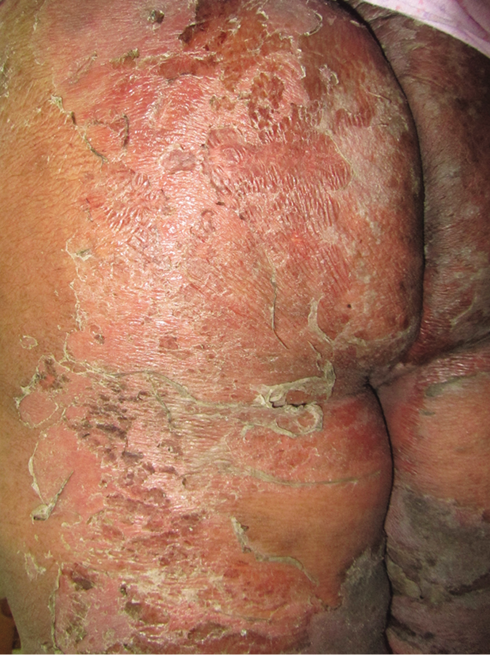 Drug reaction with eosinophilia and systemic symptoms (DRESS). TEN-like skin detachment