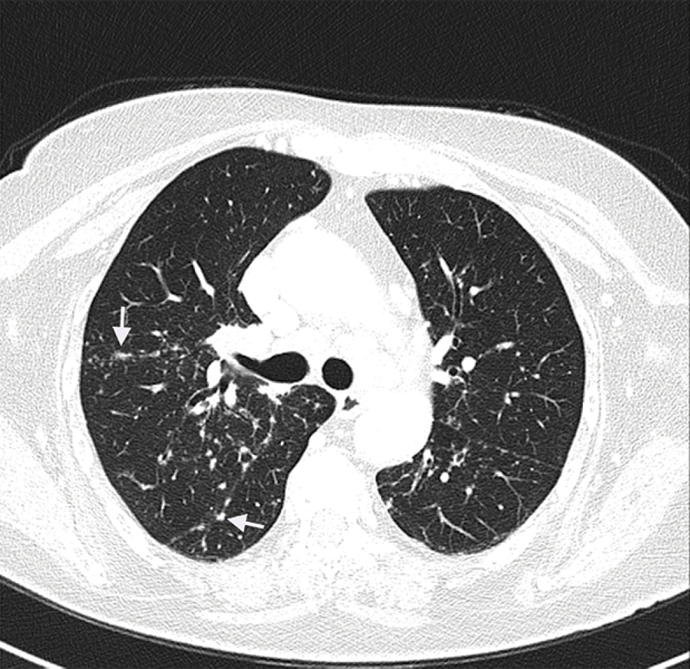 Multiple small sub-pleural, peri-bronchovascular and centrilobular nodules (arrows) in the lungs with multiple mediastinal lymphadenopathies (CT scan)