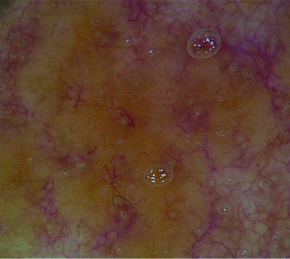 Dermoscopy showed structureless yellowish-orange areas and well-focused linear irregular vessels (×20)