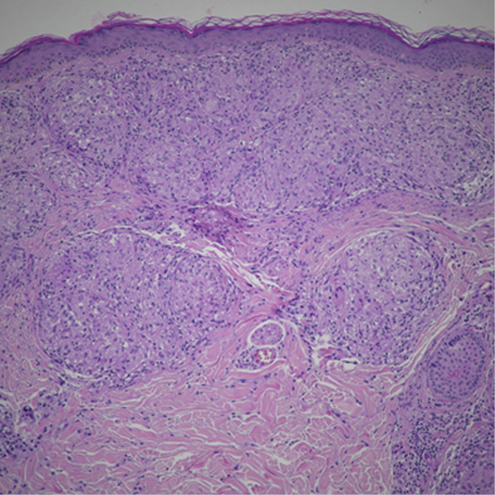 Sharply defined “naked” sarcoidal granulomas with sparse few lymphocytes and no necrosis (H&E, ×200)